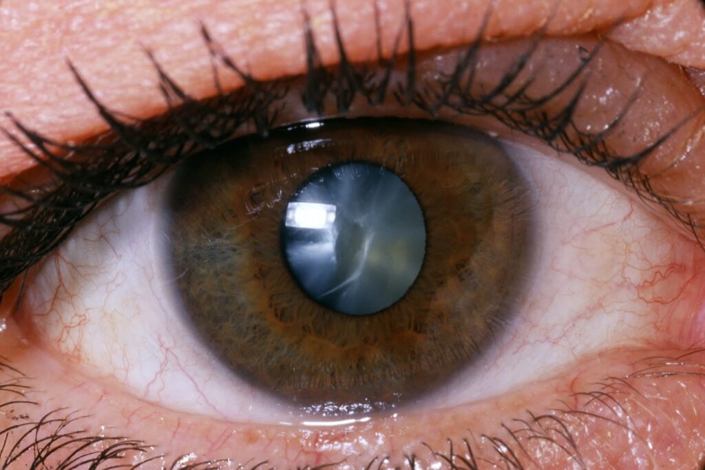 Preventing and managing vitreous loss after cataract surgery
